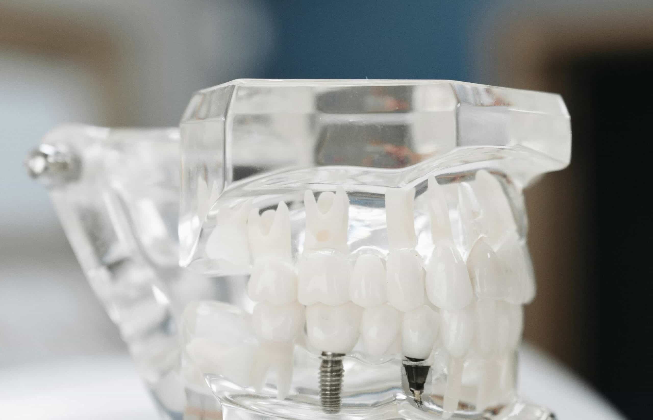 Lo que necesitas saber antes de someterte a un tratamiento de implantes dentales